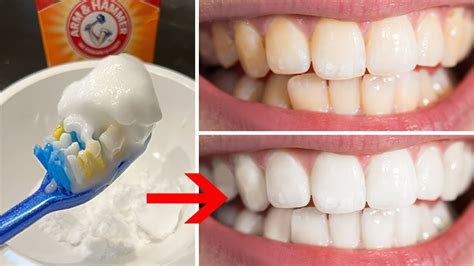 Baking Soda Teeth Before After
