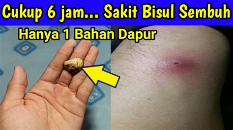 Obat Bisul Paling Ampuh, Cara Mengobati Bisul Secara Alami - YouTube