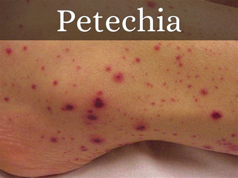 Ecchymosis Vs Petechiae