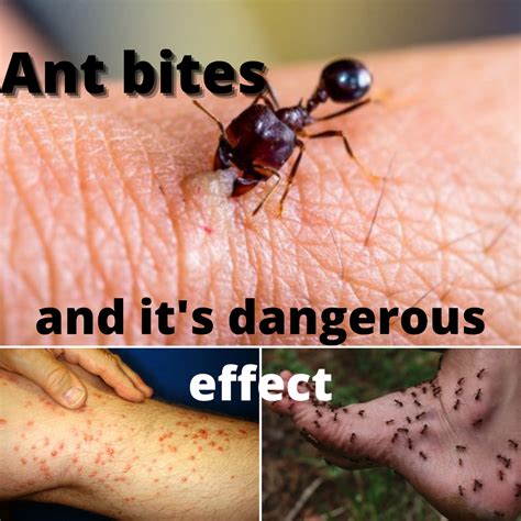 What should we do when an ant bites?