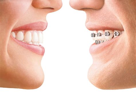 Invisalign vs. Traditional Braces | Family Dentistry of Harrisburg