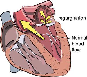 Heart Mitral Valve Regurgitation