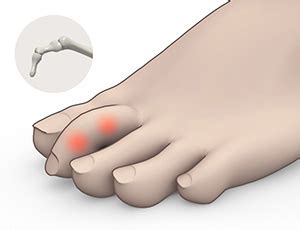 Claw Toe Treatment Lincoln NE | Toe Deformity Omaha, Grand Island