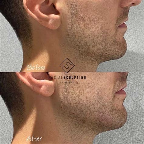 Jawline sculpting before and after: the best treatments for a defined jawline | HELLO!