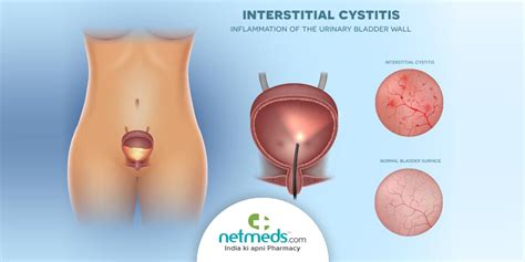 Interstitial Cystitis/Bladder Pain Syndrome: Causes, Symptoms And Treatment