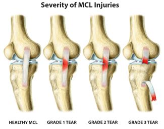 MCL Injury Information