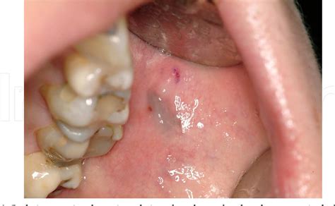 Figure 1 from Oral Malignant Melanoma | Semantic Scholar