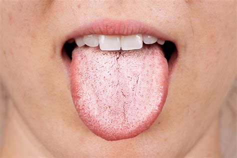 White Coating On Tongue Reflux at Maria Ellis blog