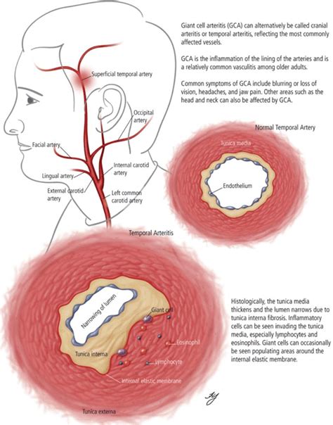 Cranial / Temporal Arteritis – Exodontia