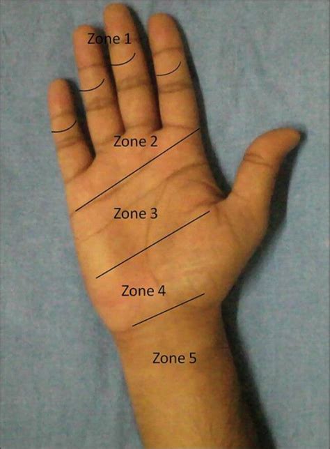 flexor tendon zones of the hand - Google Search | Hand therapy, Hand injuries, Occupational therapy