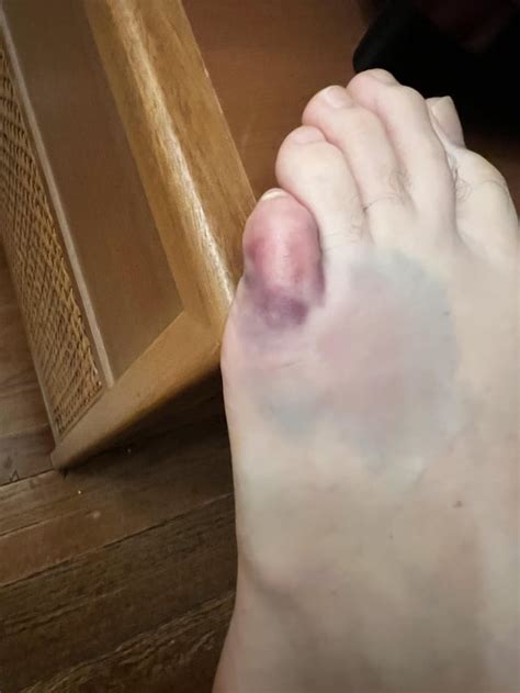 Ever stubbed your toe so hard it broke? : r/Wellthatsucks