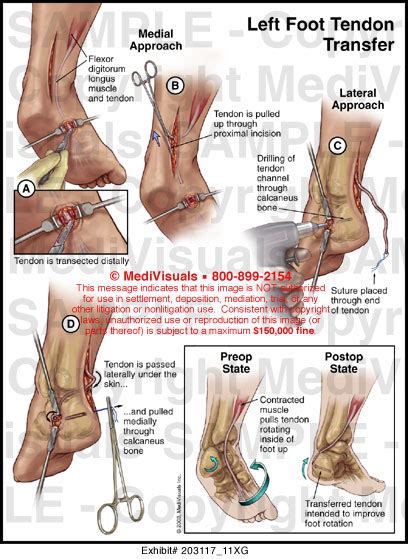 Left Foot Tendon Transfer Medical Exhibit Medivisuals