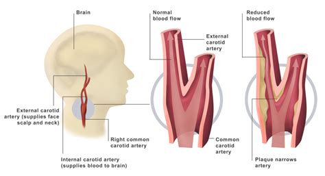 Carotid Disease Treatment - Dr. Ahmed Farah Abdulrahman