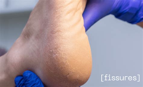 Heel Fissures Treatment and Home Care Tips | Dérmica, Edmonton, AB.