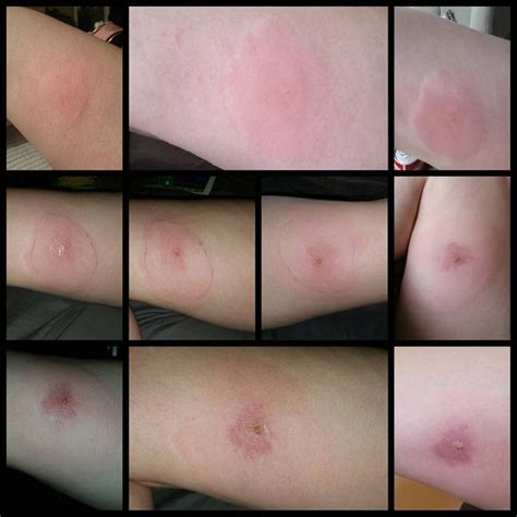 These pictures of the most common spider bites will help you figure out ...