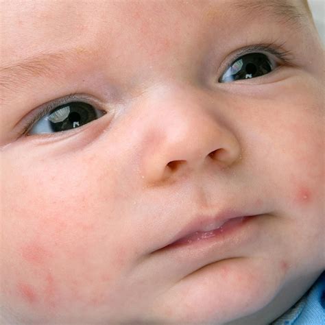 egg allergy rash on face baby - Leatrice Coward