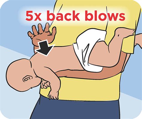 Choking first aid for babies: in pictures | Raising Children Network