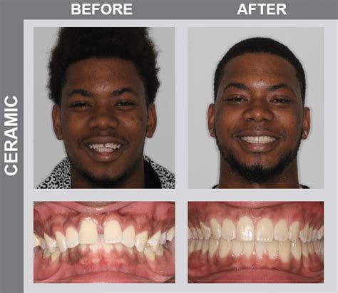 Smile Gallery | Before and Afters | NCOSO Orthodontics