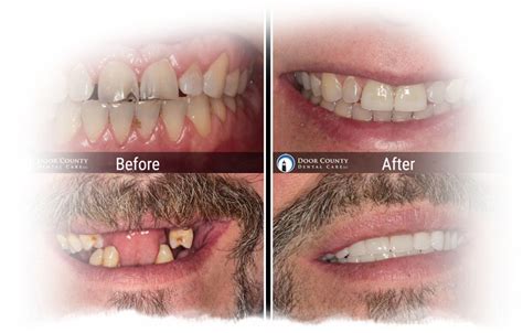 Cosmetic Dentistry Before and After Photos from Door County Dental Care