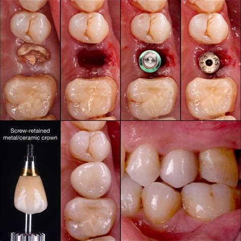 🇬🇧Immediat implant placement after the extraction of hopeless second ...