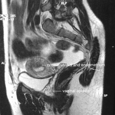 MRI aspect with a sagittal incidence showing the presence of normal and... | Download Scientific ...