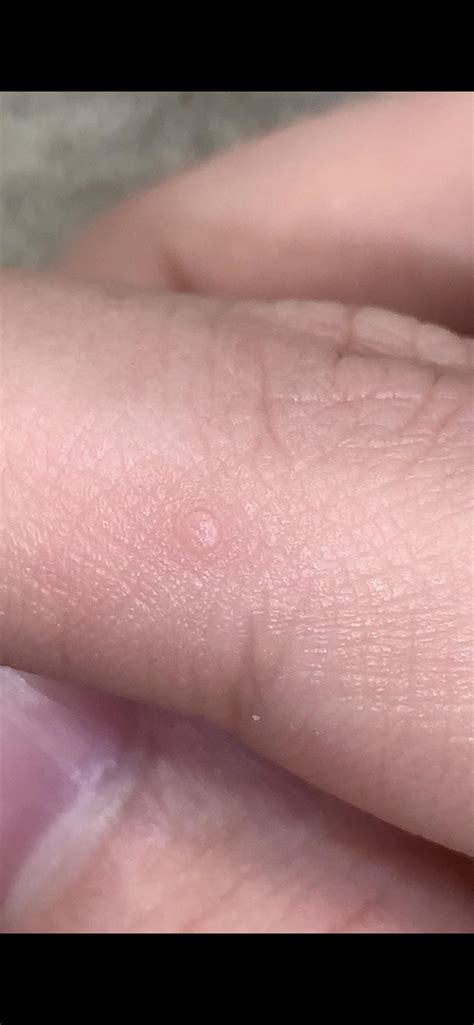 is this a wart. on the side of my finger. Had it for over 2 years ...