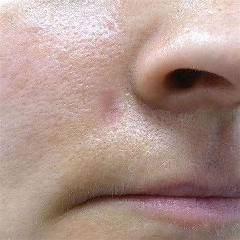 Collection 104+ Pictures Mole Removal Healing Stages Pictures Excellent