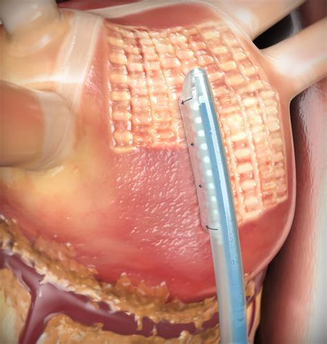 Minimally Invasive Ablation to Treat Atrial Fibrillation | AtriCure