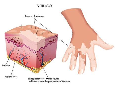 Vitiligo: Symptoms, Complications, and Treatment