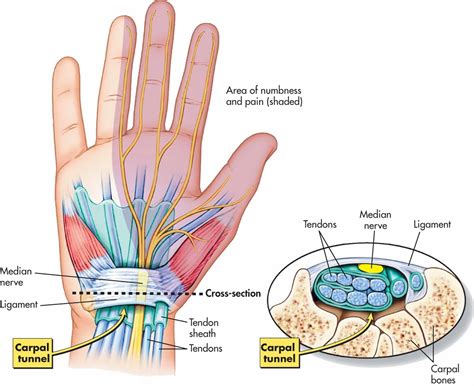 Carpal Tunnel Syndrome Explained