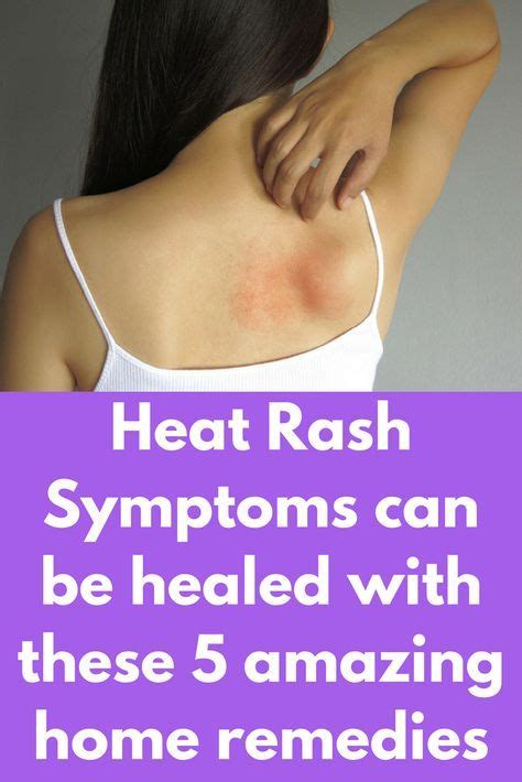 Heat Rash Symptoms can be healed with these 5 amazing home remedies Heat rashes can be ...