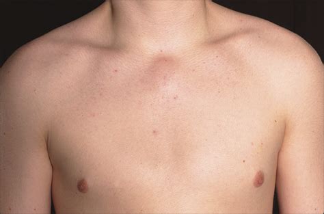 Cystic Swelling Overlying the Upper Sternum in a Teenager—Quiz Case | Adolescent Medicine | JAMA ...