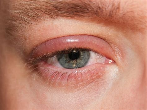 Facts About Conjunctivitis (Pink Eye) in Older Adults - HubPages