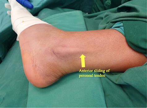 Peroneal Tendon Subluxation Surgery