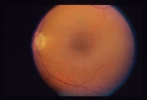 Cystoid Macular Edema (CME) - Retina Image Bank