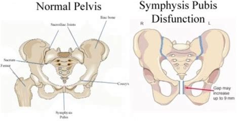 Symphysis Pubis Dysfunction - Symptoms, Treatment, What is?,