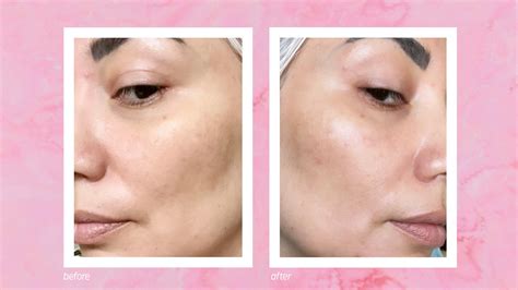 How to Treat Acne, Uneven Texture, and Large Pores | Allure