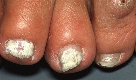 Onychomycosis: Types, Symptoms, Causes, Diagnosis, Risk Factors and Treatment - Scope Heal