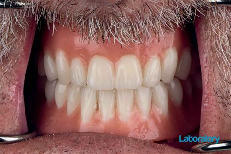 Edentulous patient case with better precision - Dentistry