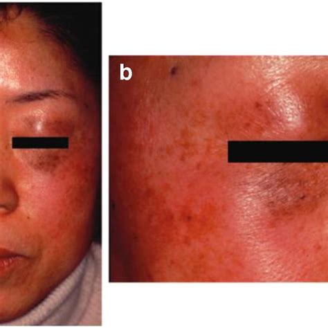 Periorbital hyperpigmentation. (a) Pretreatment. (b) Immediately after ...