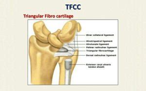 TFCC: Triangular Fibrocartilage Complex Injuries - MHT