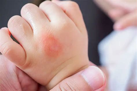 5 Types Of Skin Allergies In Babies, Treatment & Prevention