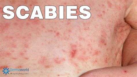 What Do Scabies Look Like On Humans
