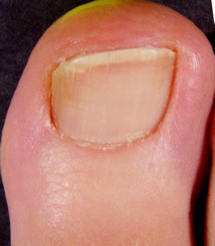 Fungal nail (Onychomycosis) treatment – Skin Cosmetics London