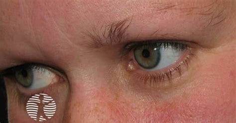 Anagen effluvium: loss of eyebrows in alopecia areata image