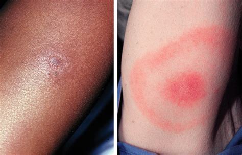 Lyme Disease Rash – 𝗗𝗜𝗔𝗚𝗡𝗢𝗦𝗜𝗦 𝟭𝟮𝟯