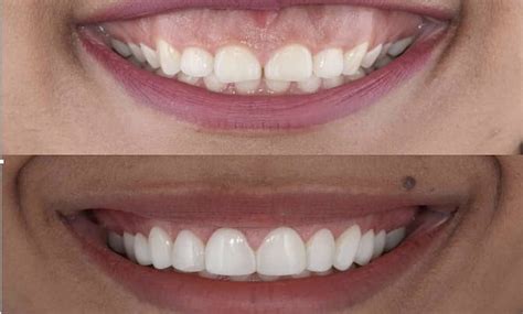 Sonrisa Gingival: Qué es, causas y tratamiento. | Clínica dental ...