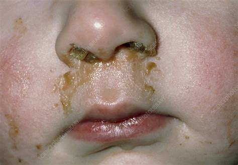 Rhinitis: mucus & pus discharge from child's nose - Stock Image - M130/0391 - Science Photo Library
