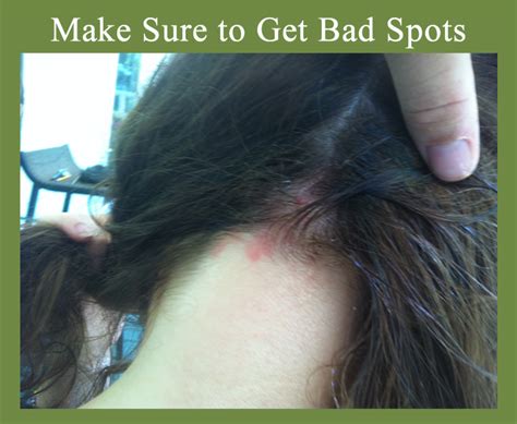 Natural Scalp Psoriasis Treatment With Tea Tree Oil and Olive Oil - HubPages