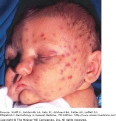 Child With Congenital Cmv